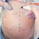 برگزاری مسترکلاس کاشت و ترمیم مو در دبی
